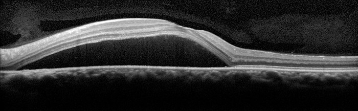 A continuing education event about Central Serous Chorioretinopathy with Retinology - Canterbury Eyecare